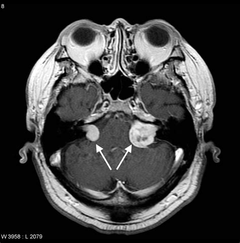 acoustic neuroma type 2